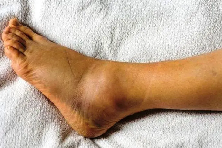 Kaki Bengkak Karena Asam Urat? Ini 5 Cara Cepat Mengatasinya!